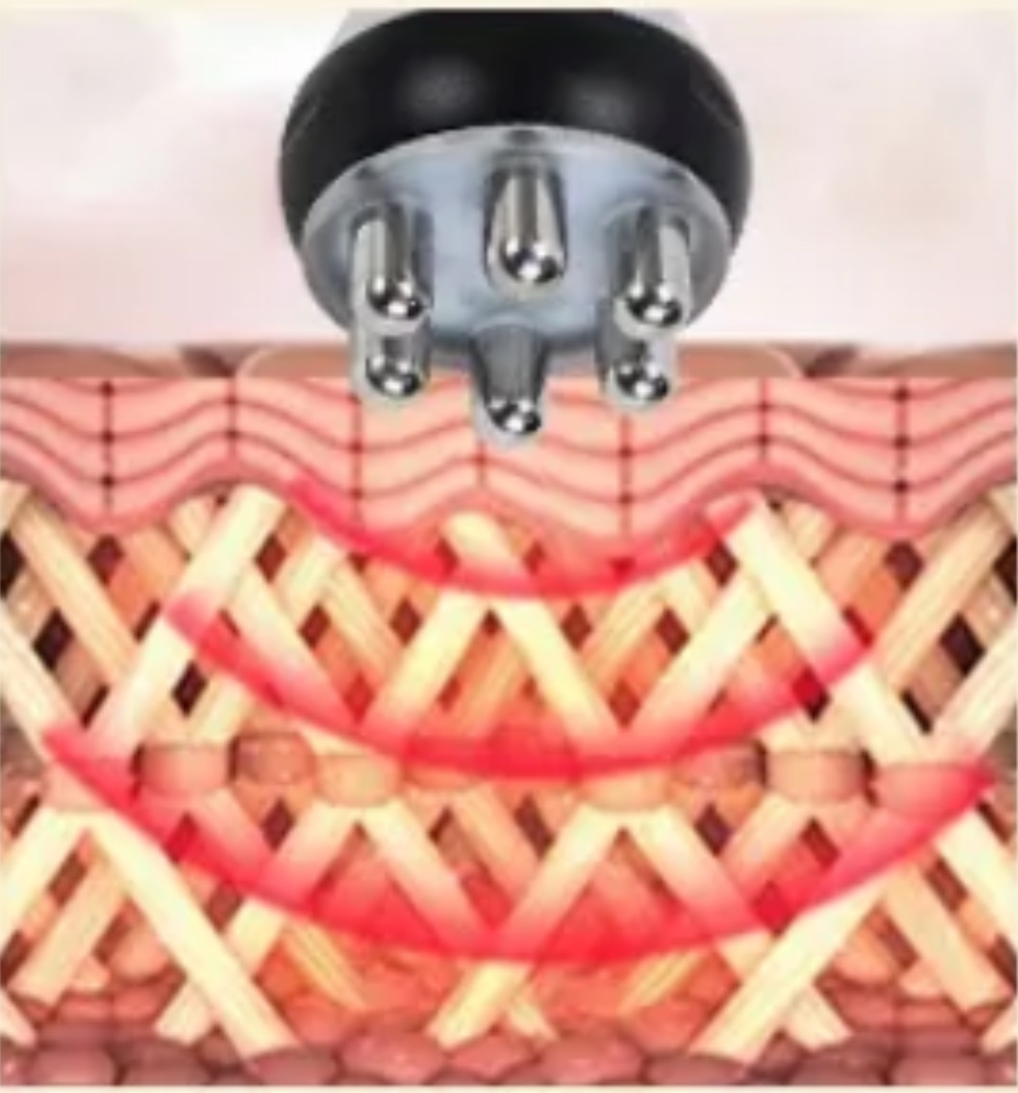 Radio Frequency Treatment
