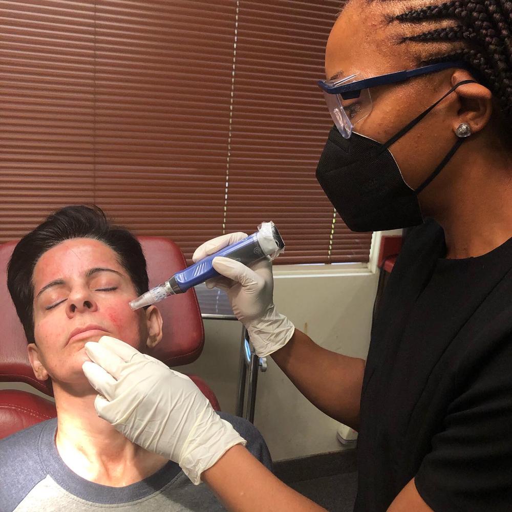 Microneedling