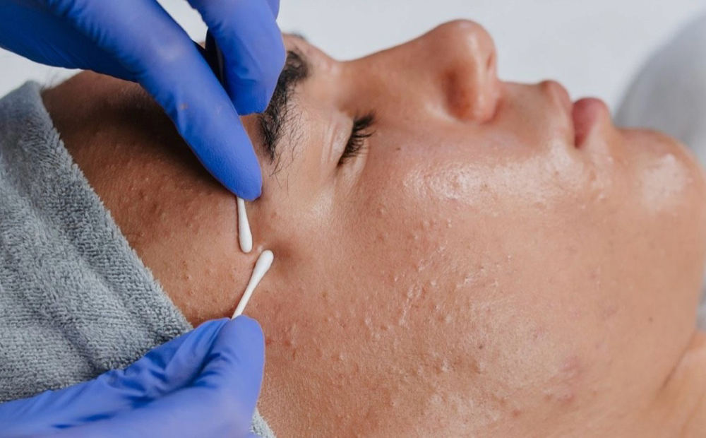 Teen Facial Treatment + Extractions