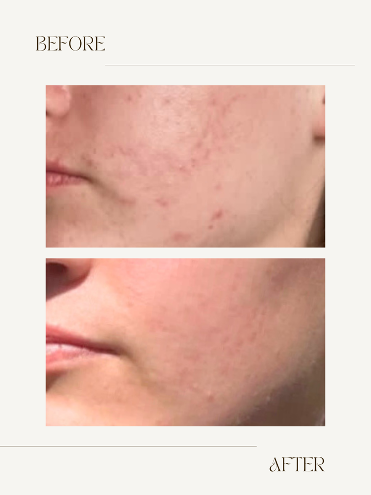 Procell Microchanneling