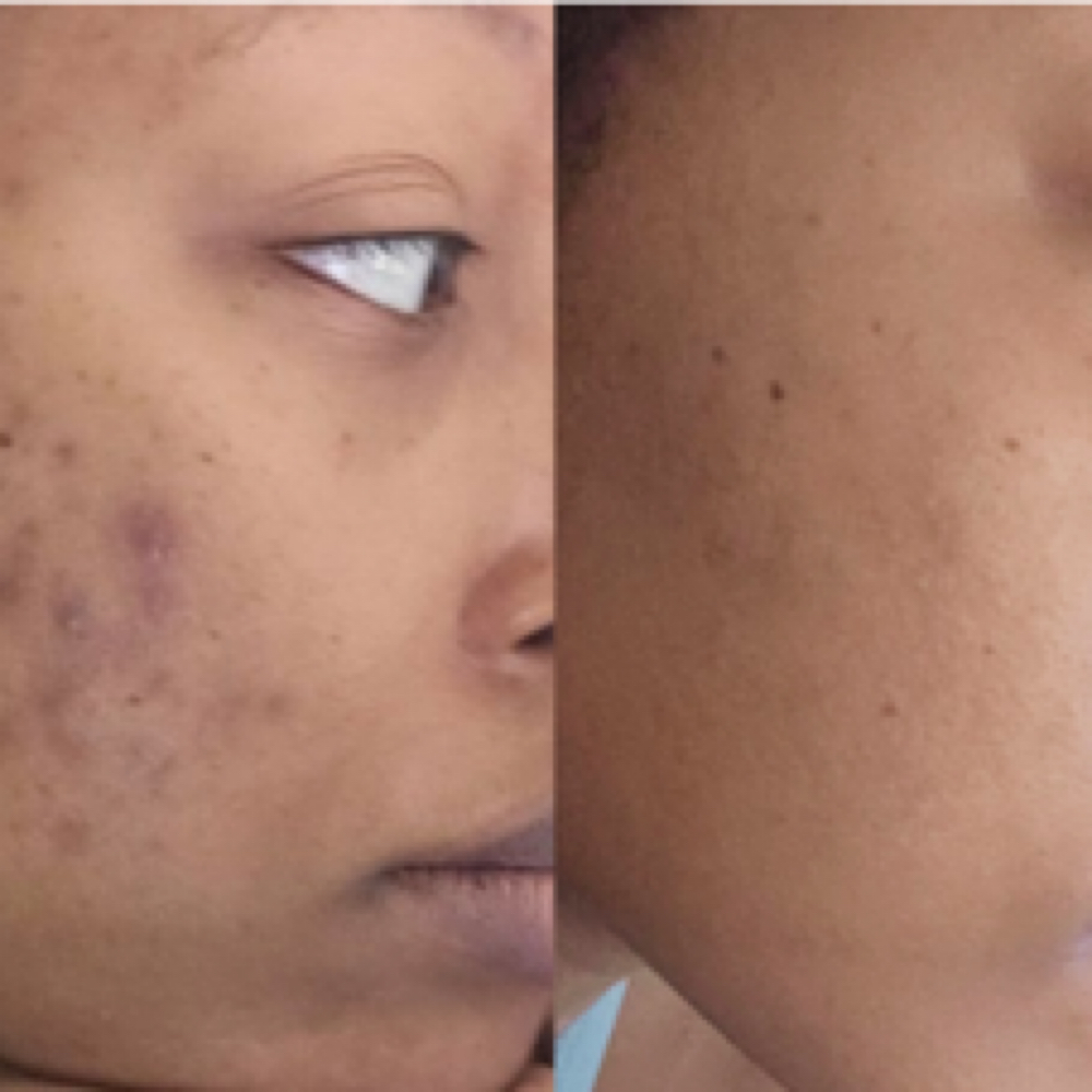 Body Brightening Treatment Peel🍃 at Tayselfcarestudio LLC in Lawrence, MA