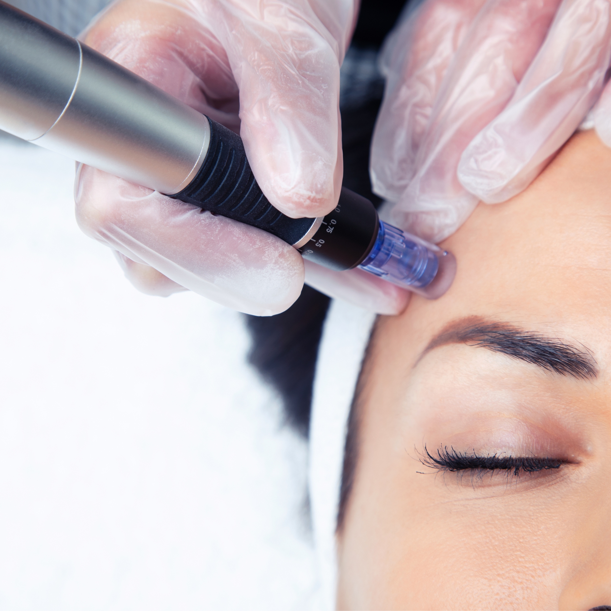 Nano Needling – Face & Neck