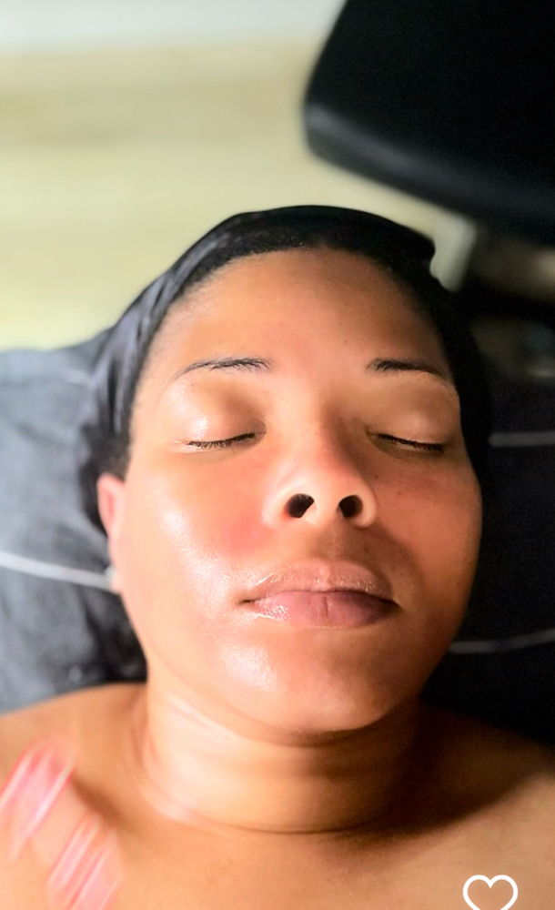 Glycolic Acid Peel