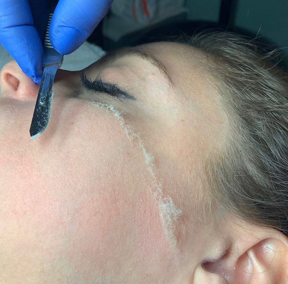 Dermaplaning Facial