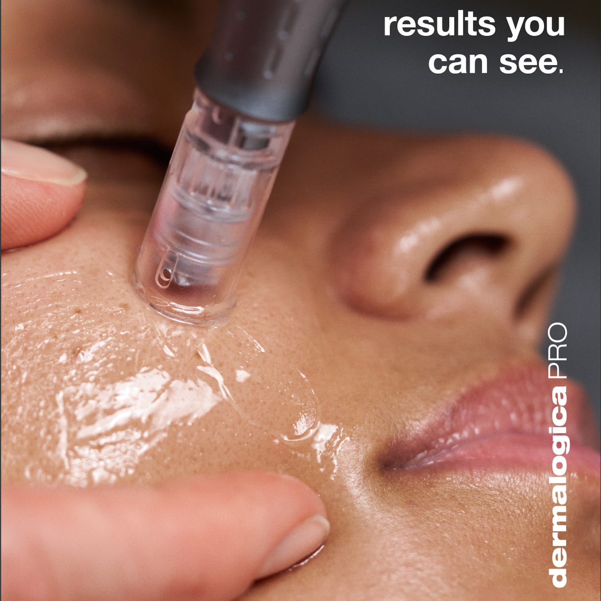 Microneedling at Healing Touch Esthetics in Port Jefferson Station, NY
