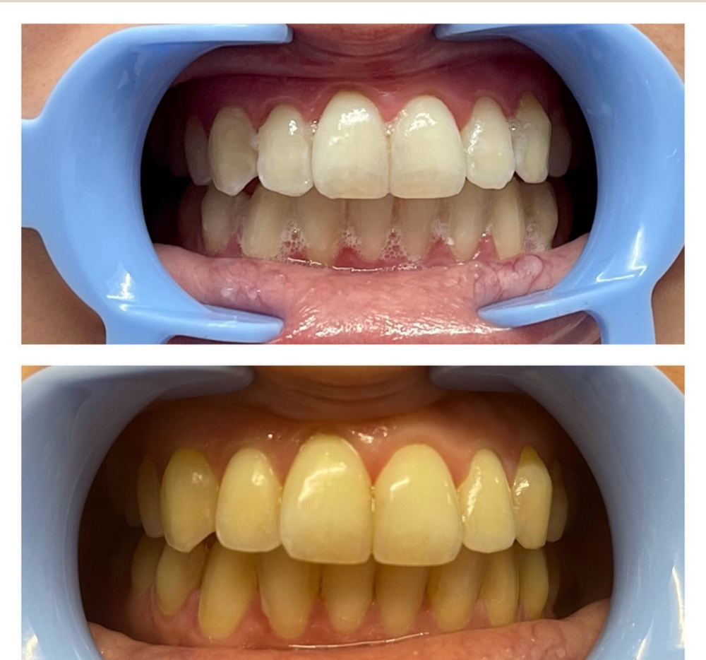 Teeth Whitening