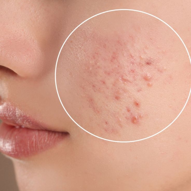 Clarifying Acne Facial