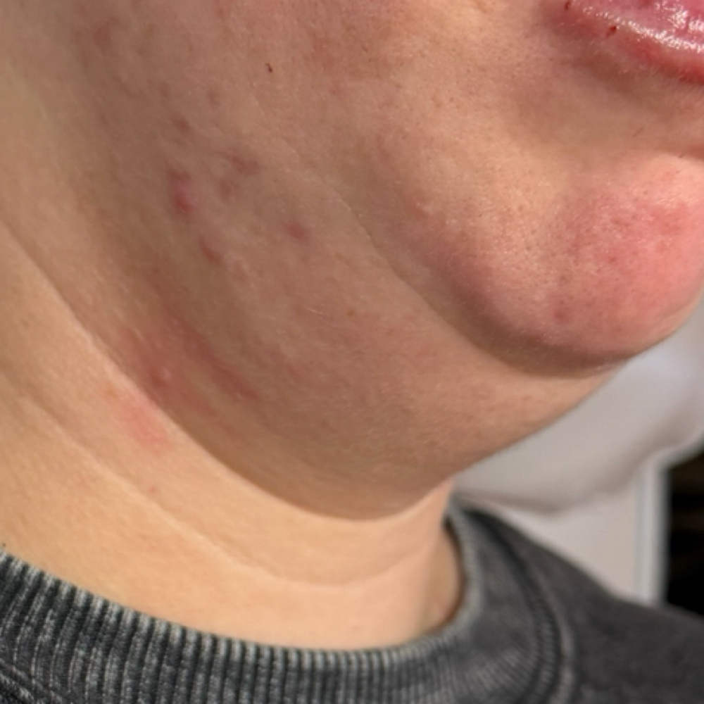 Underchin Fat Dissolver 1 Session at Nouvelle Vie Beauty in Cibolo, TX