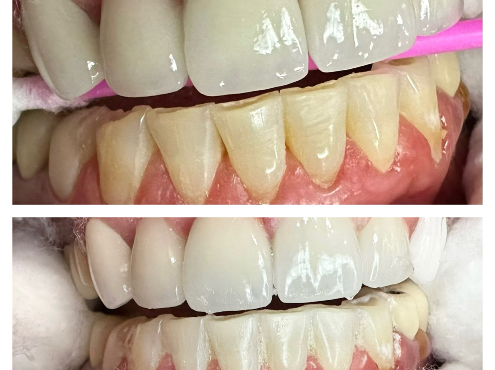 Home Whitening Kit Deluxe