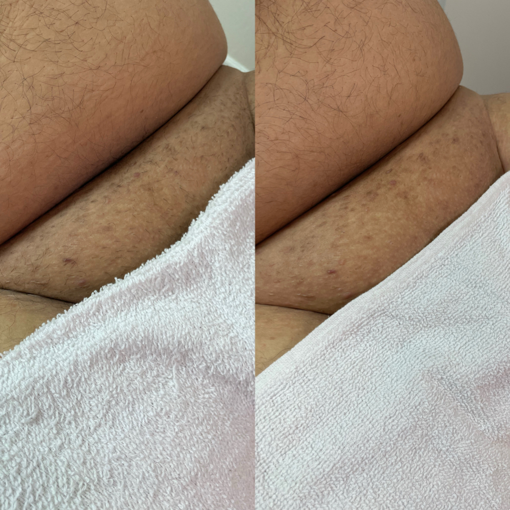 Manzilian at Liv Beautiful Esthetics in CA, CA