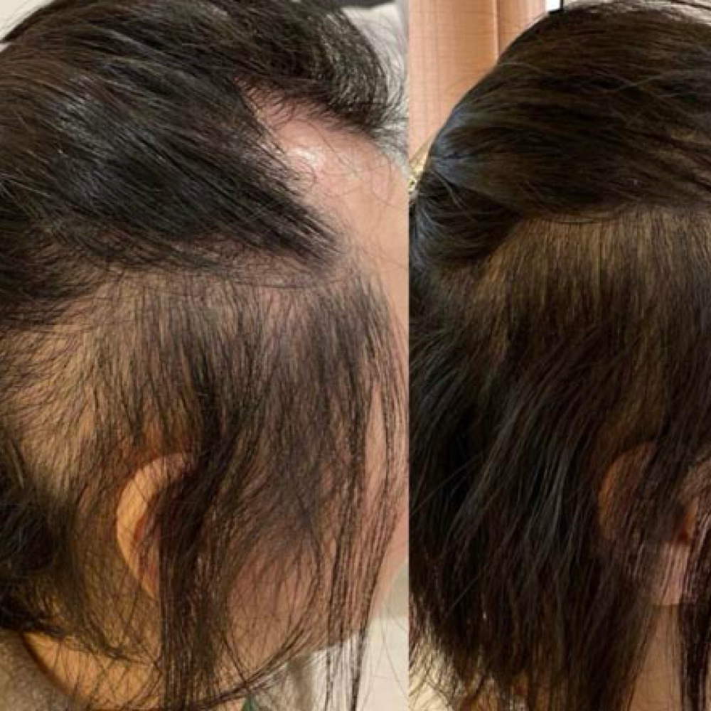 Procell Hair Restoration at The Crown House SA in San Antonio, TX