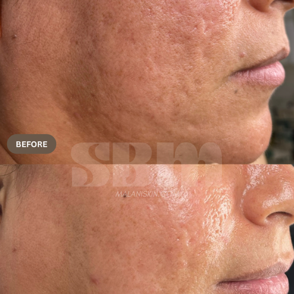 SCAR THERAPY WITH STEMCELLS at SBM SKIN STUDIO in Whittier, CA