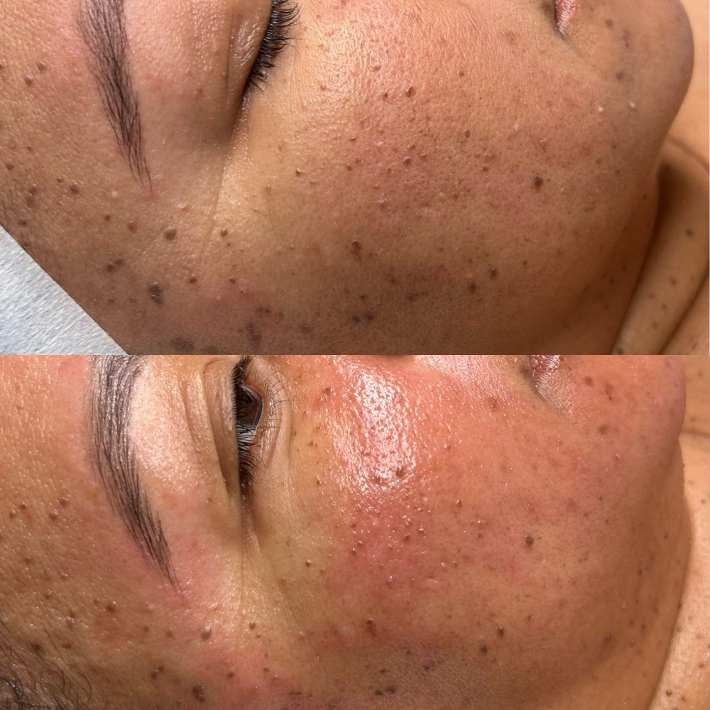 Women’s Microdermabrasion
