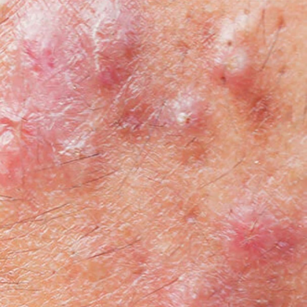 Acne Facial at Jou Beauty Glow llc in New York, NY