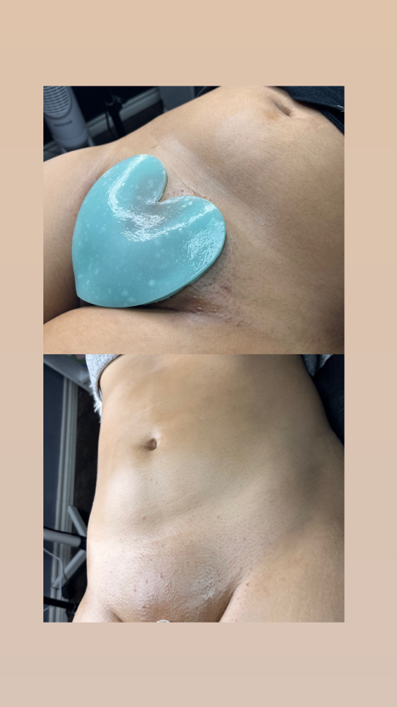 Full Tummy+Brazilian+hydrojelly