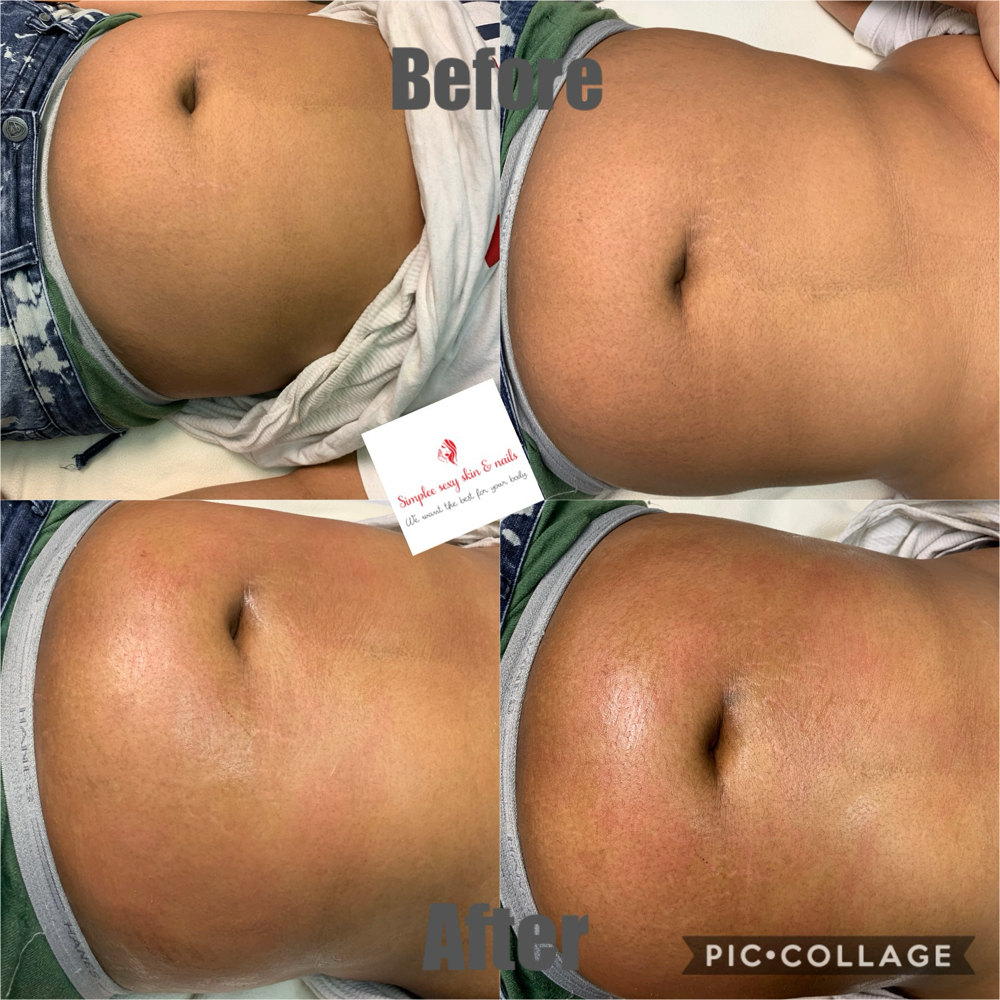 Radiofrequency Skin Tightening
