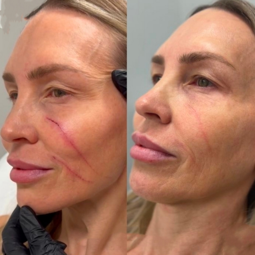 Scar Revision at BeautyPlanetbyBarbie in PRINCETON, NJ