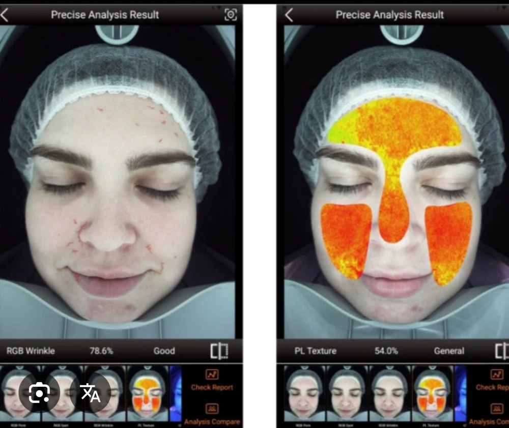 Vera Face Skin Analysis