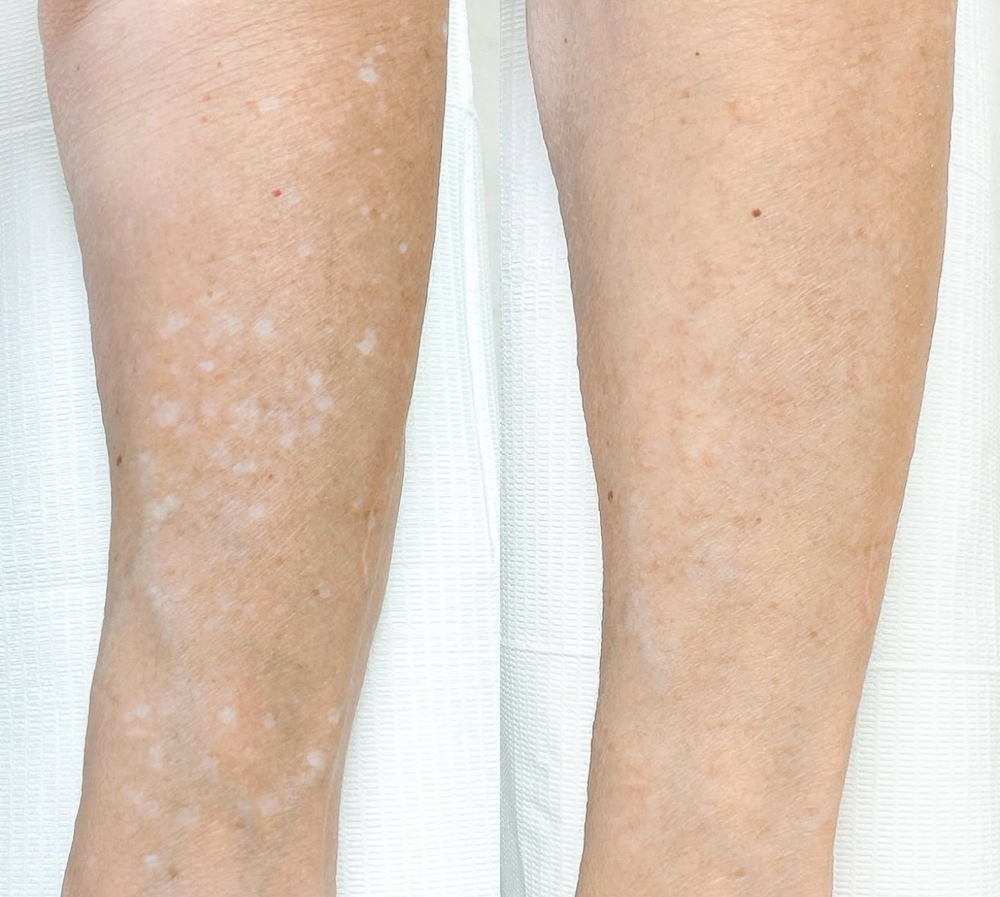 Skin camouflage