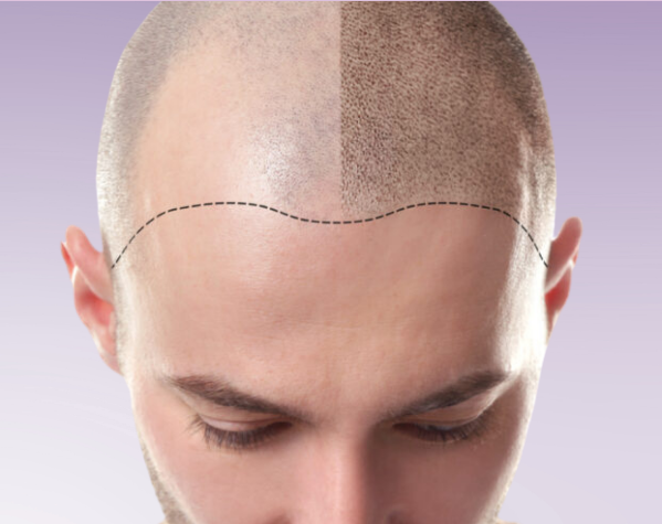 MEN Scalp Micropigmentation