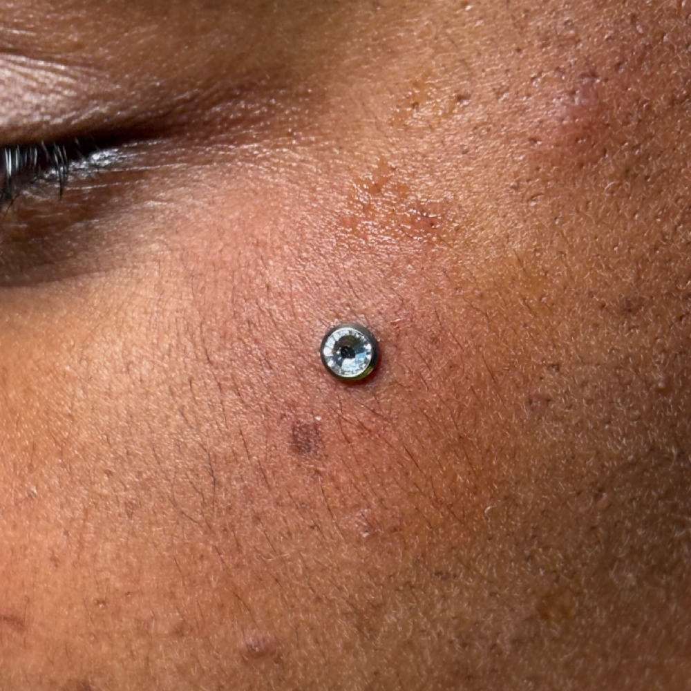 Dermal Removal at PunkturedByKal in Arlington, TX