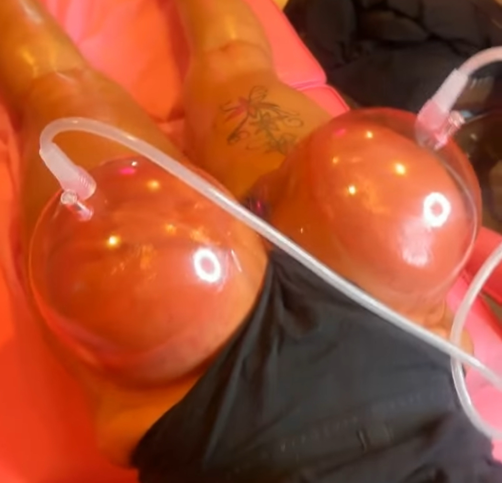 Vacuum Buttocks Therapy