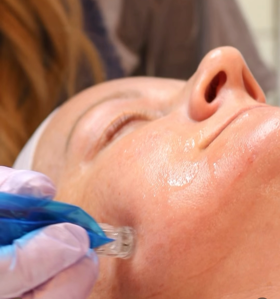 RF Microneedling Single Session at Kit’s Lash & Skin Studio at Soleil Spa in Pleasant Grove, UT