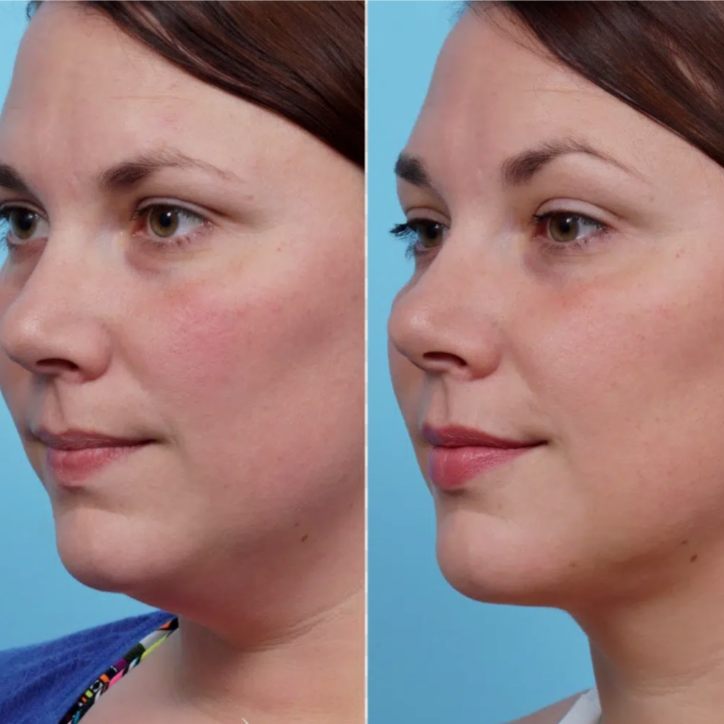 4 Double Chin Slimming treatments at Glo'Up Body Spa in Atlanta, GA