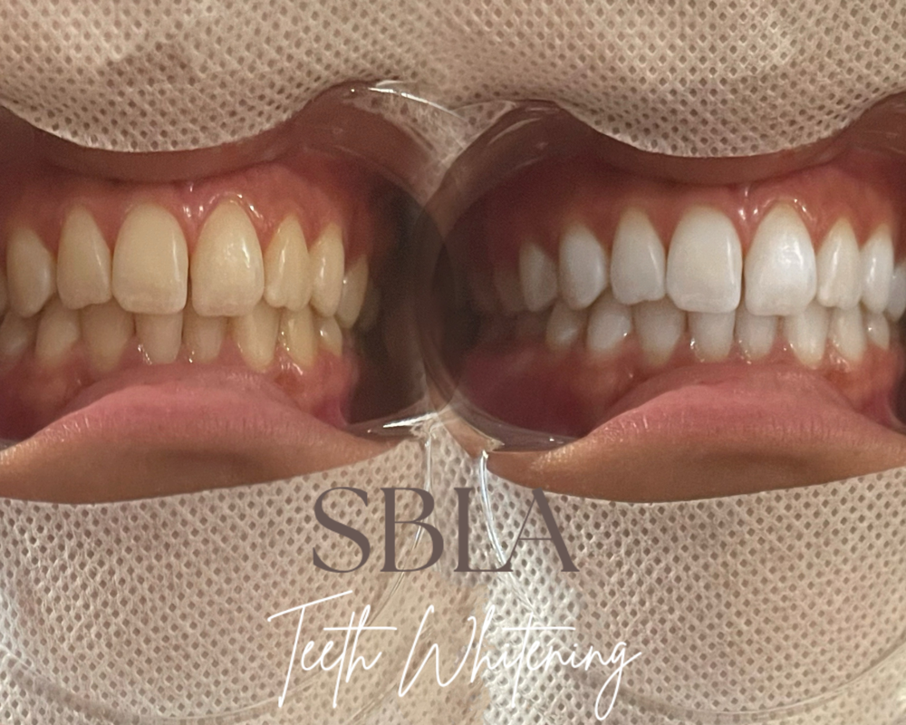 Teeth Whitening  Follow up at Studio Bronze LA in Whittier, CA