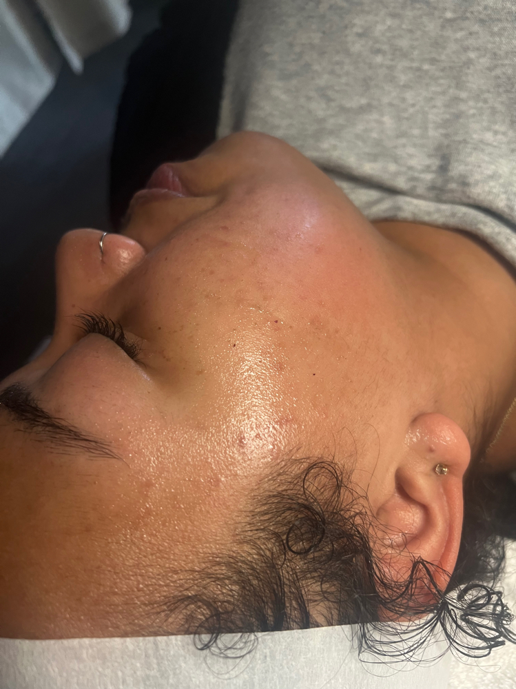 Dermaplane Facial