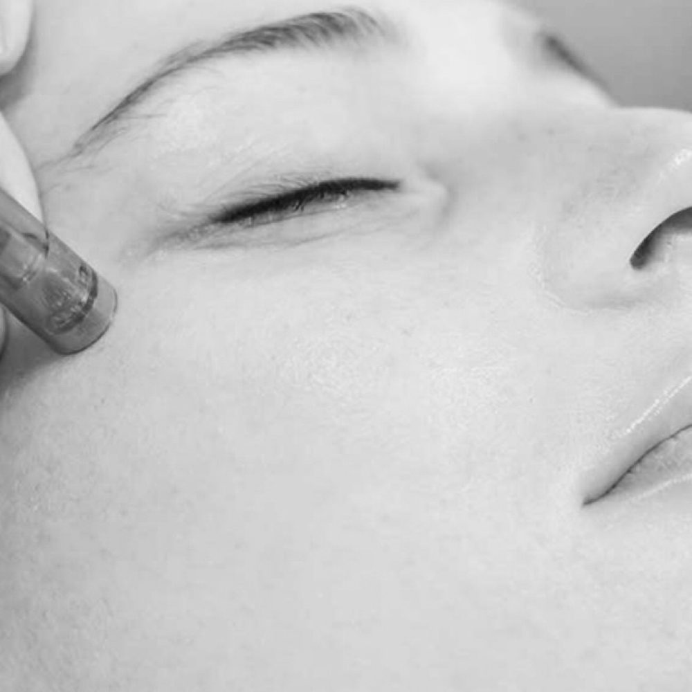 Microneedling: Face, Neck, Chest at Beauty by Makenna in Lincoln, NE