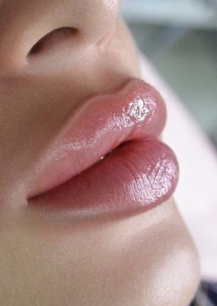 Lip Filler at Luxehaus aesthetics & wellness by Cynthia Lucio in Bolingbrook, IL