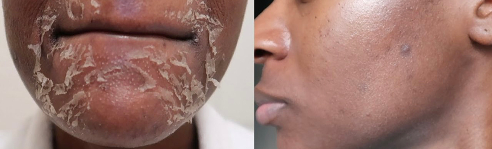 Mandeli Clear Peel