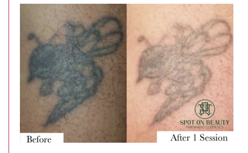 Tattoo Saline Removal 8 Week Follow