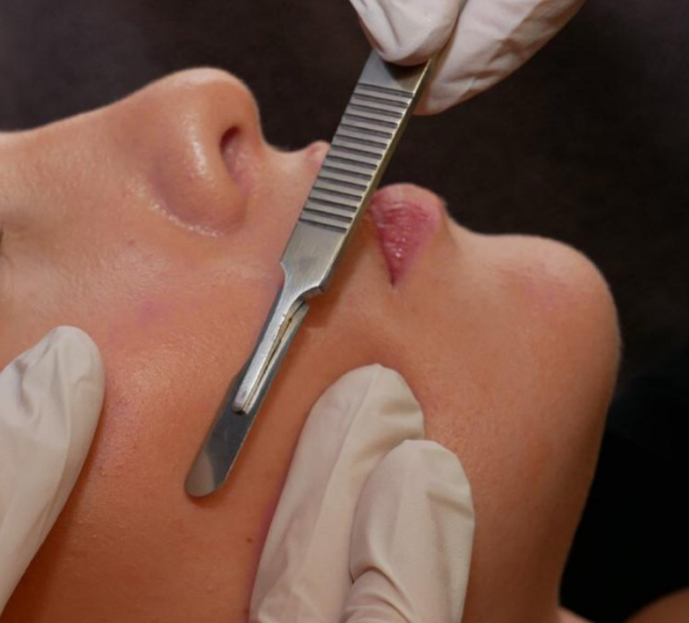 DERMAPLANING EXPRESS FACIAL at Bliss Skin by Sam LLC in Lafayette, IN