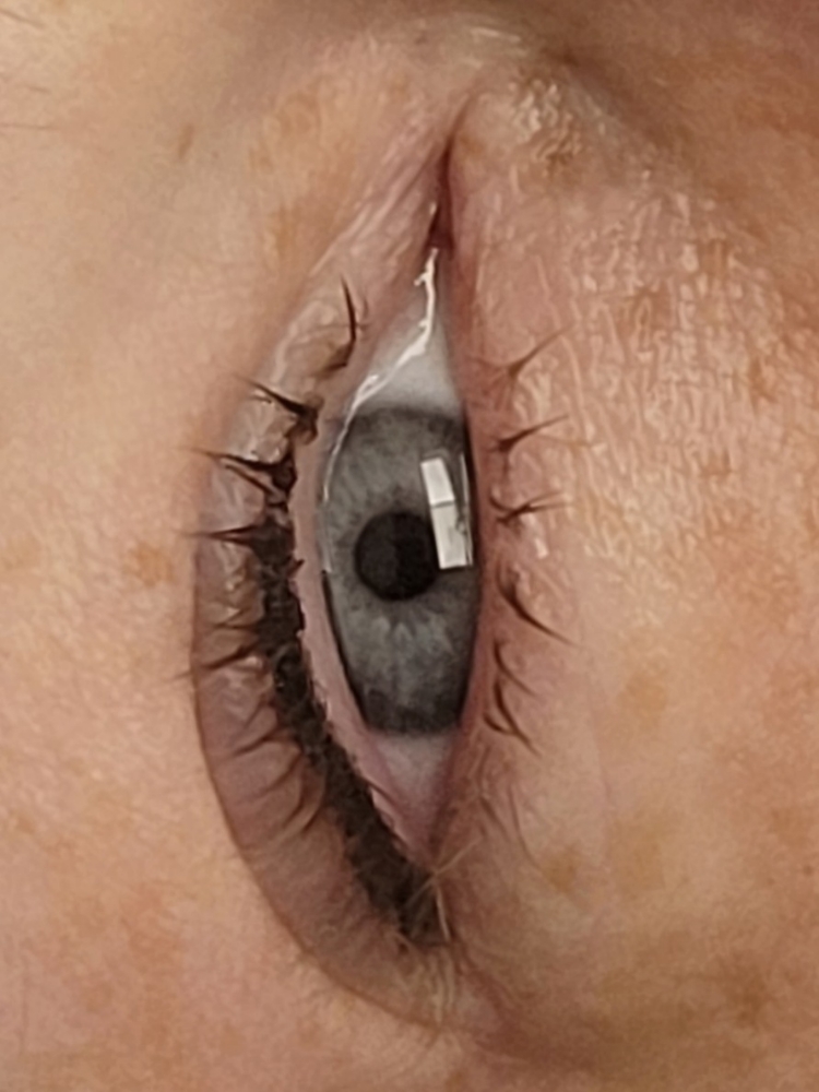 Lash Enhancement