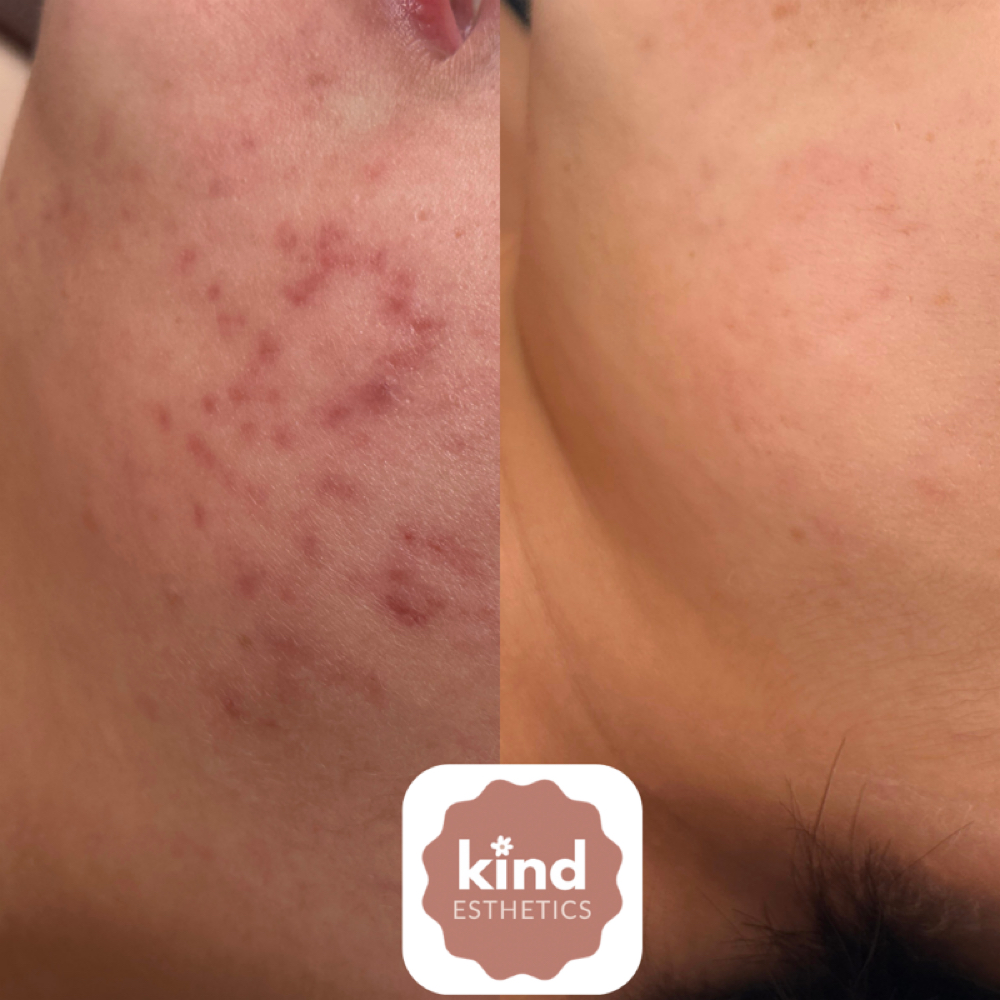 Scarring & Pigmentation Consult at Kind Esthetics in Spring, TX
