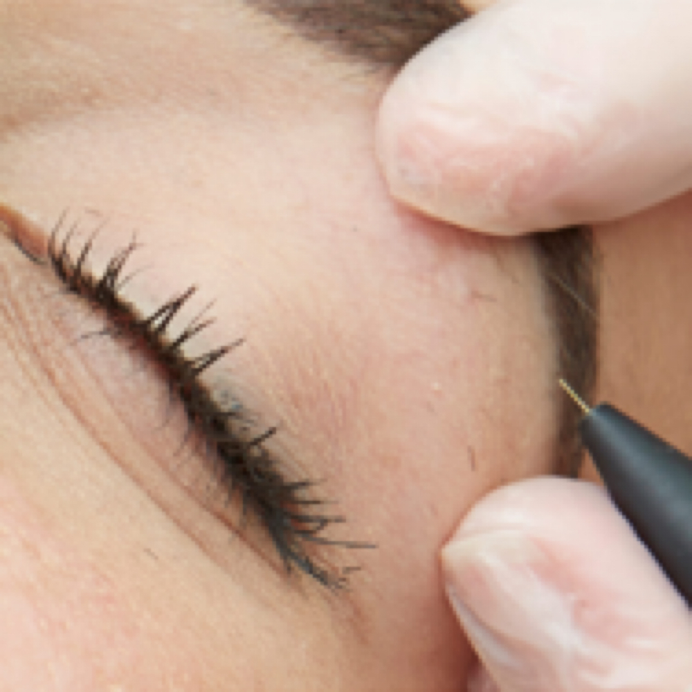 Electrolysis at Aura Electrolysis | Laser | Threading in Ashland, MA