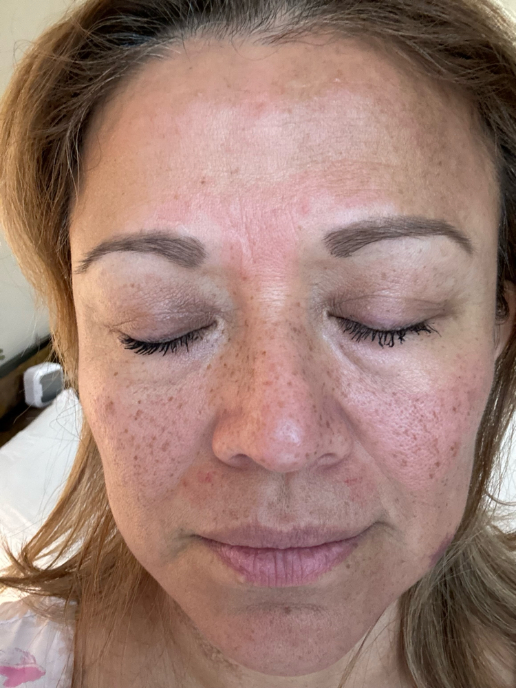 Radiant Glow MicroNeedling Facial