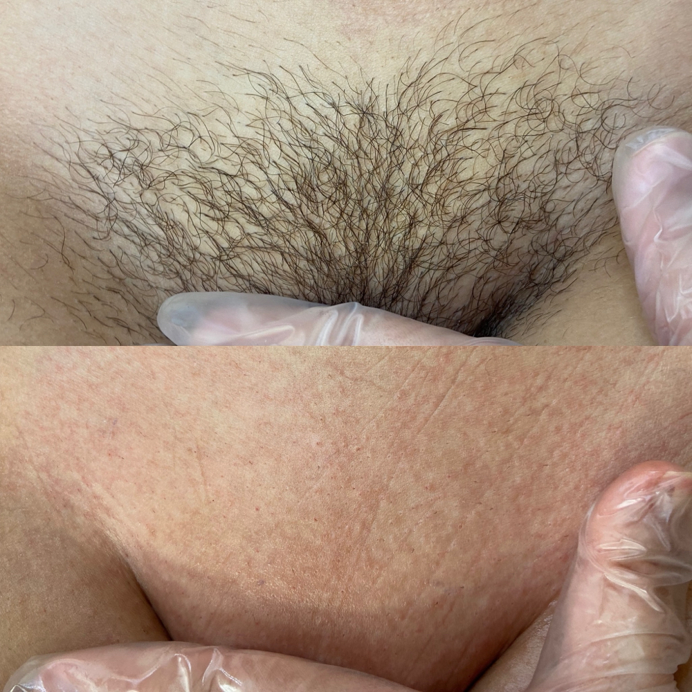 Brazilian wax at with love, beauty in miami, FL