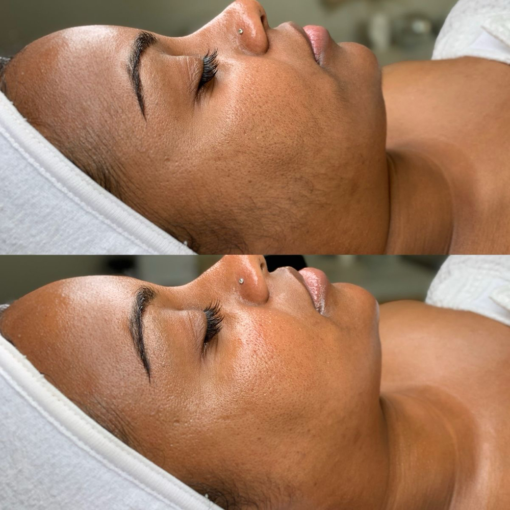 Dermaplaning Facial