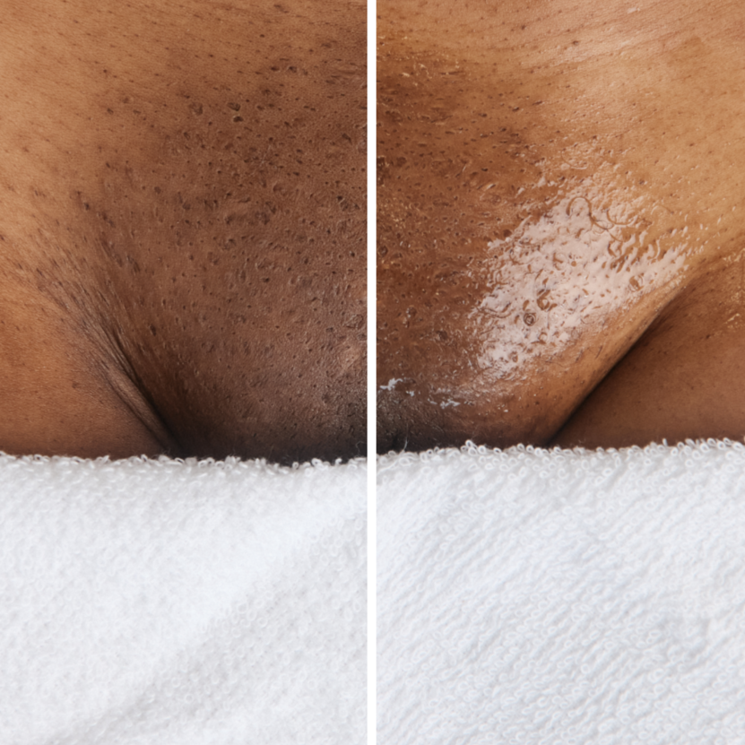 Brightening Vajacial Deluxe at Bareline Aesthetics in Brea, CA