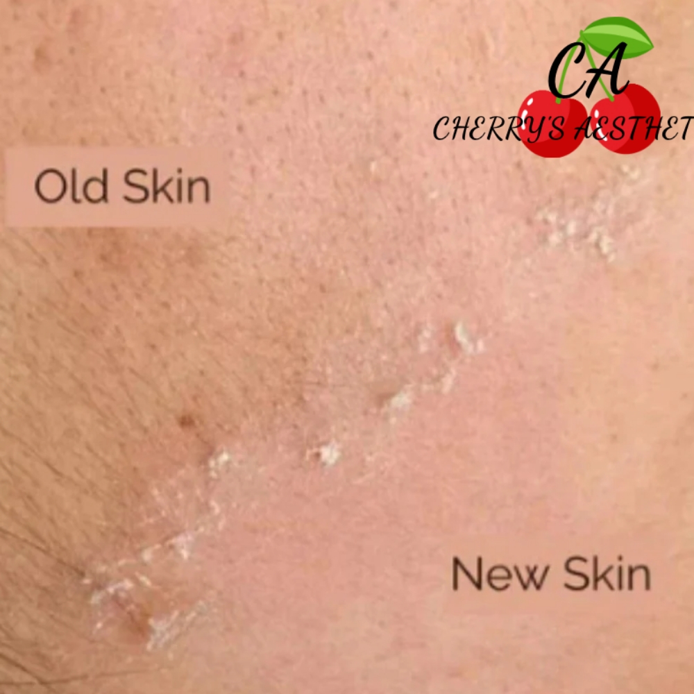 Dermaplaning at Cherry's Aesthetics in Chillicothe, OH