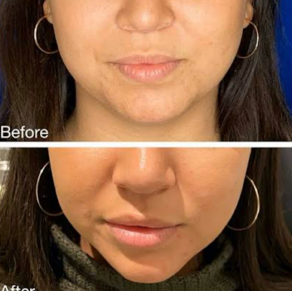 Jaw Lines Treatment at Bliss Beauty Bar in Houston, TX