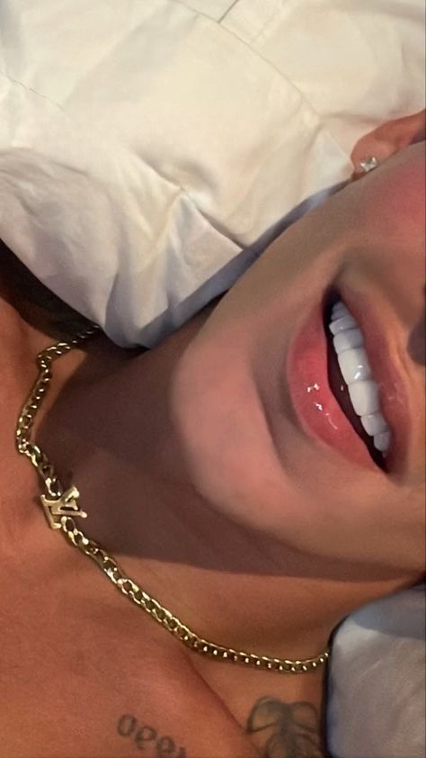 Composite Veneers 10x10