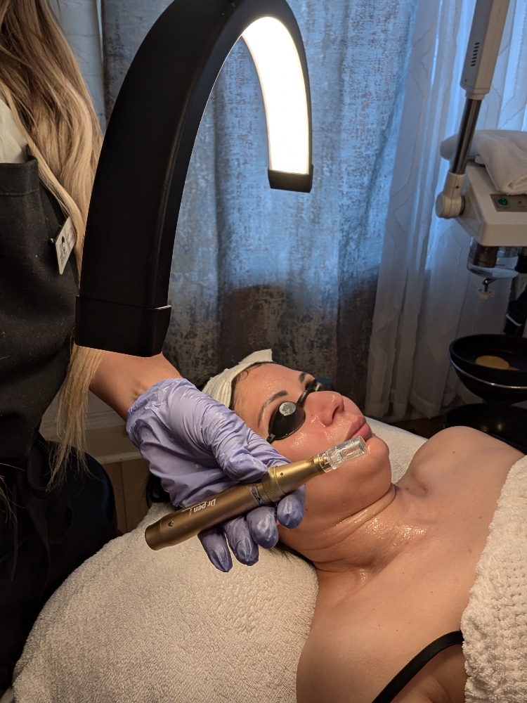 Micro needling Facial