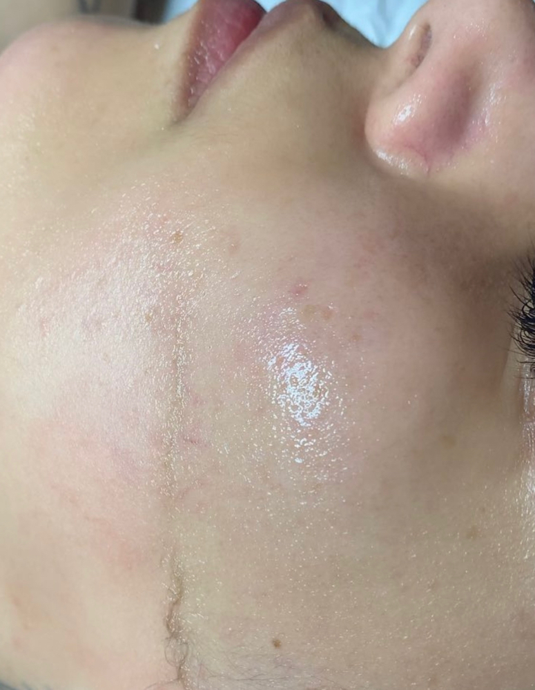Add on Dermaplane