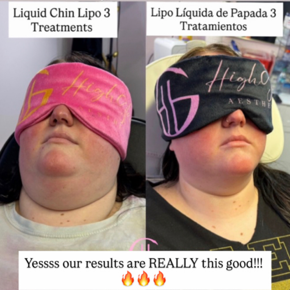 Non-Surgical LiquidLipo ModelPrices at HighGlam Aesthetics in Houston, TX