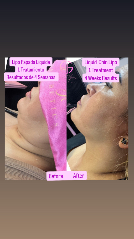 Non-Surgical LiquidLipo ModelPrices