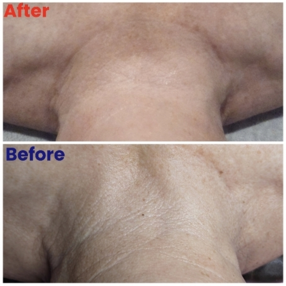 Hifu Neck/ Dellocate Treatment at Sun Skincare LLC in Scottsdale, AZ